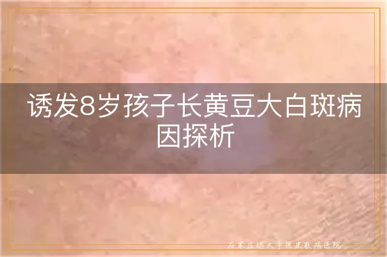 诱发8岁孩子长黄豆大白斑病因探析
