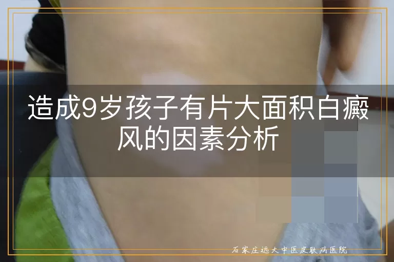 造成9岁孩子有片大面积白癜风的因素分析