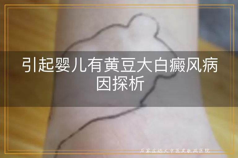 引起婴儿有黄豆大白癜风病因探析