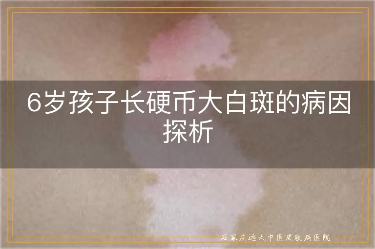 6岁孩子长硬币大白斑的病因探析