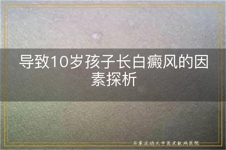 导致10岁孩子长白癜风的因素探析