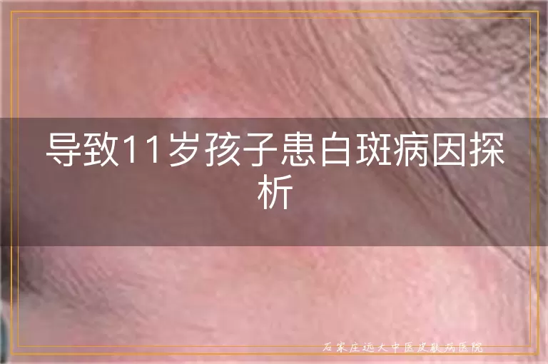 导致11岁孩子患白斑病因探析
