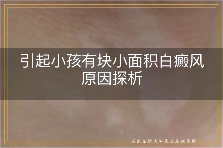 引起小孩有块小面积白癜风原因探析