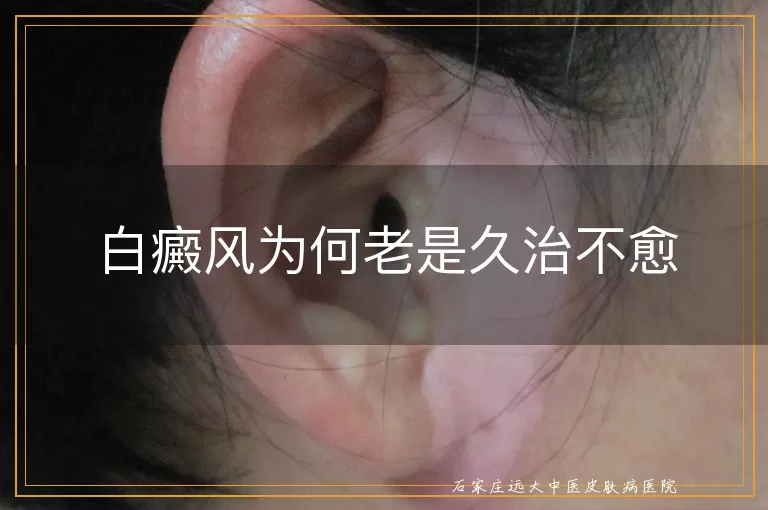 白癜风为何老是久治不愈