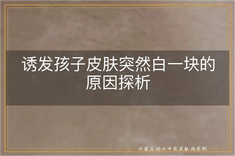 诱发孩子皮肤突然白一块的原因探析