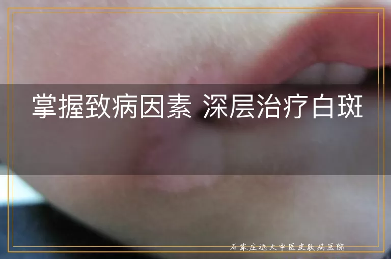 掌握致病因素 深层治疗白斑