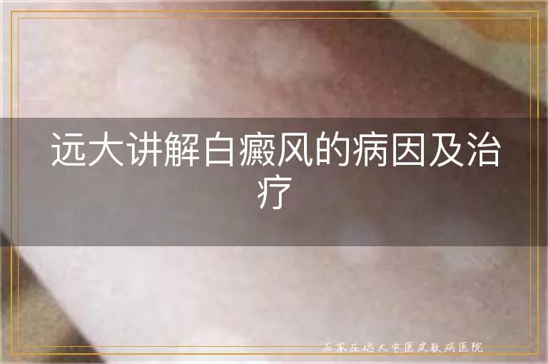 远大讲解白癜风的病因及治疗