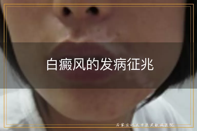 白癜风的发病征兆
