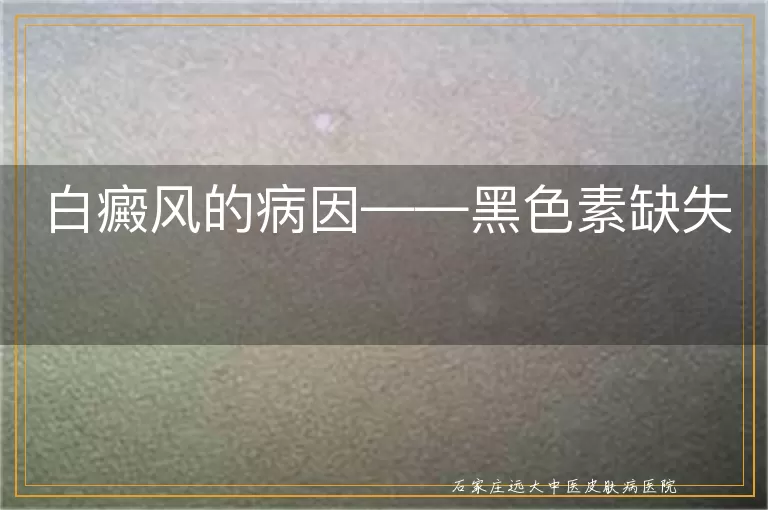 白癜风的病因——黑色素缺失