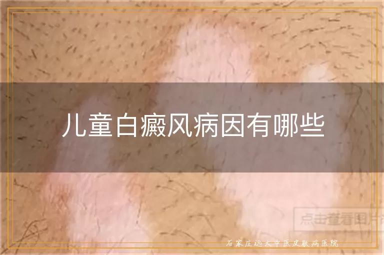 儿童白癜风病因有哪些