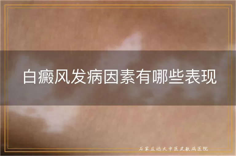 白癜风发病因素有哪些表现