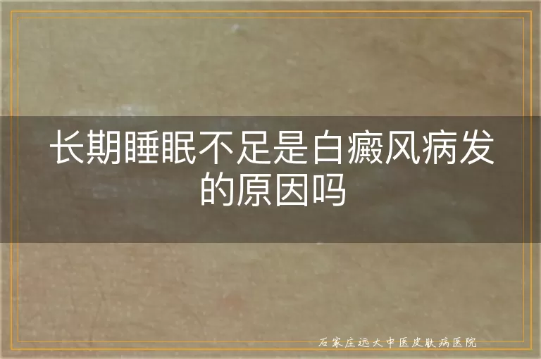 长期睡眠不足是白癜风病发的原因吗
