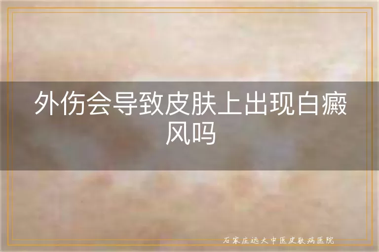 外伤会导致皮肤上出现白癜风吗