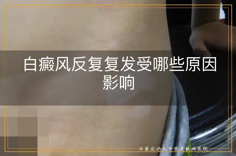 白癜风反复复发受哪些原因影响