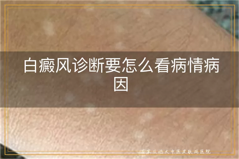 白癜风诊断要怎么看病情病因