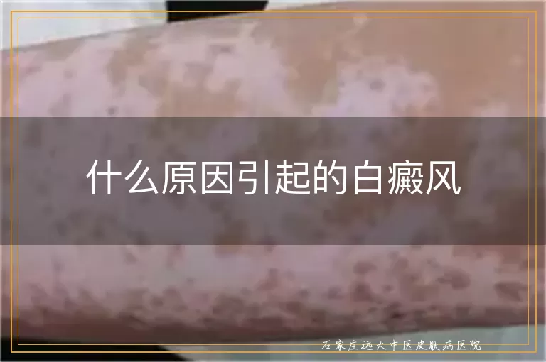 什么原因引起的白癜风