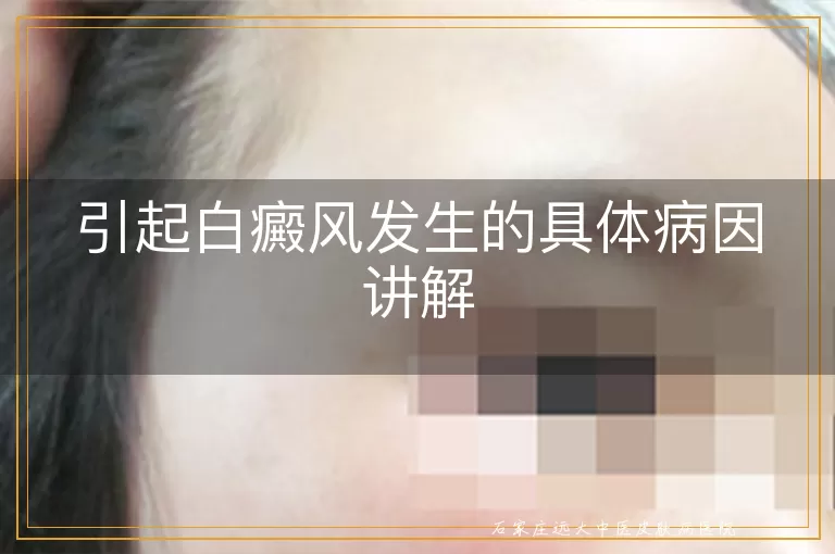 引起白癜风发生的具体病因讲解