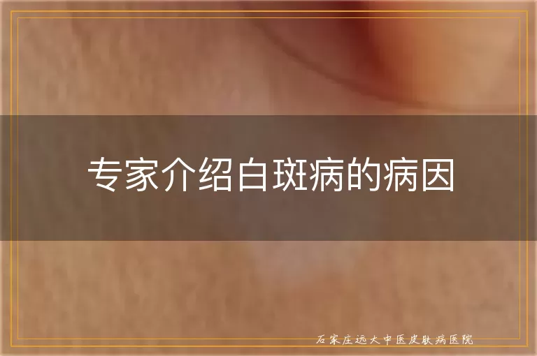 专家介绍白斑病的病因