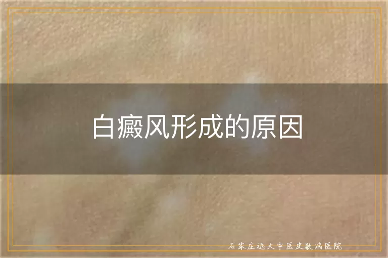 白癜风形成的原因