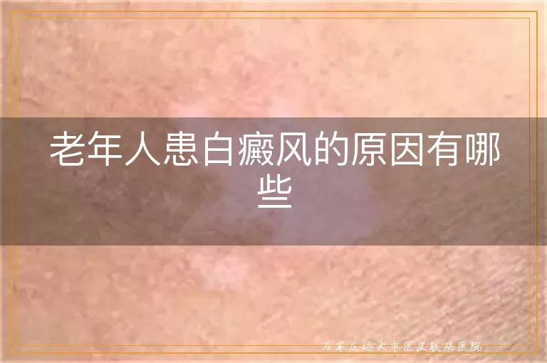 老年人患白癜风的原因有哪些
