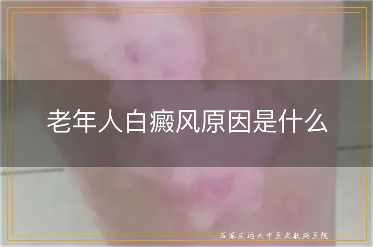 老年人白癜风原因是什么