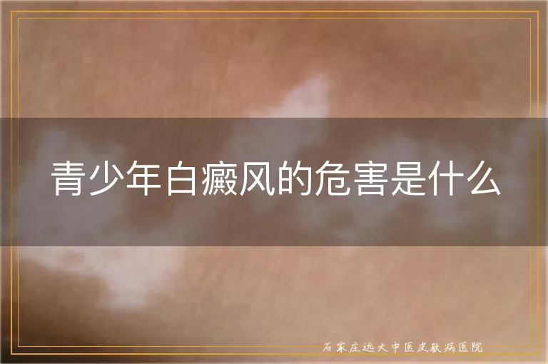 青少年白癜风的危害是什么