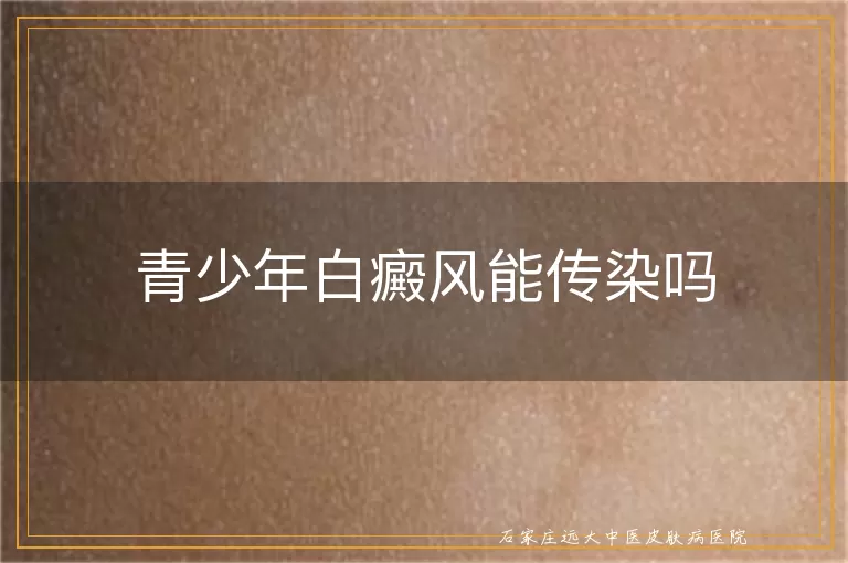 青少年白癜风能传染吗