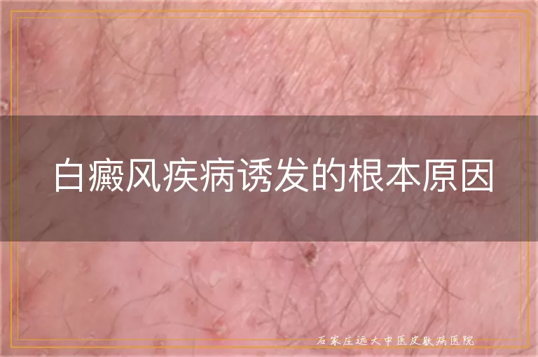 白癜风疾病诱发的根本原因