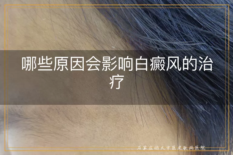 哪些原因会影响白癜风的治疗