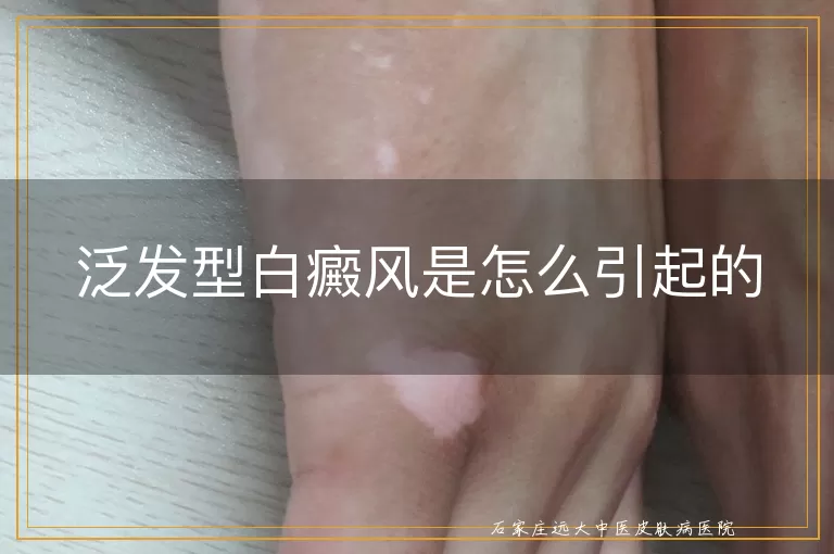 泛发型白癜风是怎么引起的