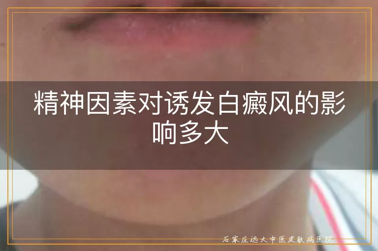 精神因素对诱发白癜风的影响多大
