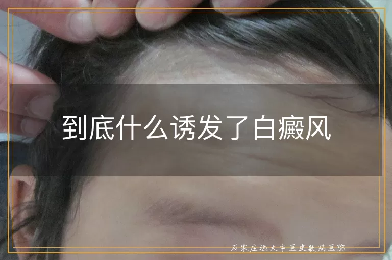 到底什么诱发了白癜风