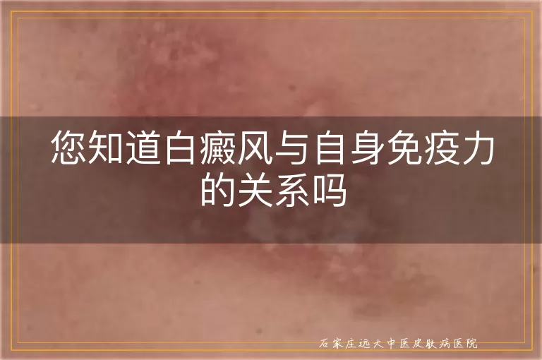 您知道白癜风与自身免疫力的关系吗