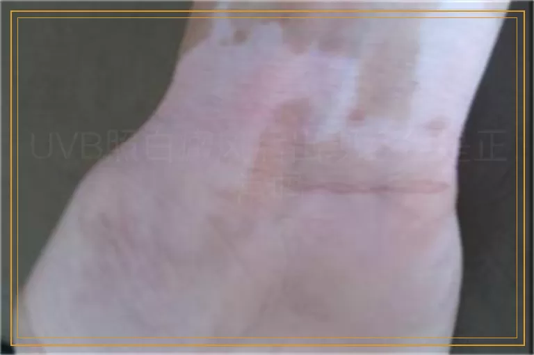 UVB照白癜风后出现红色是正常吗