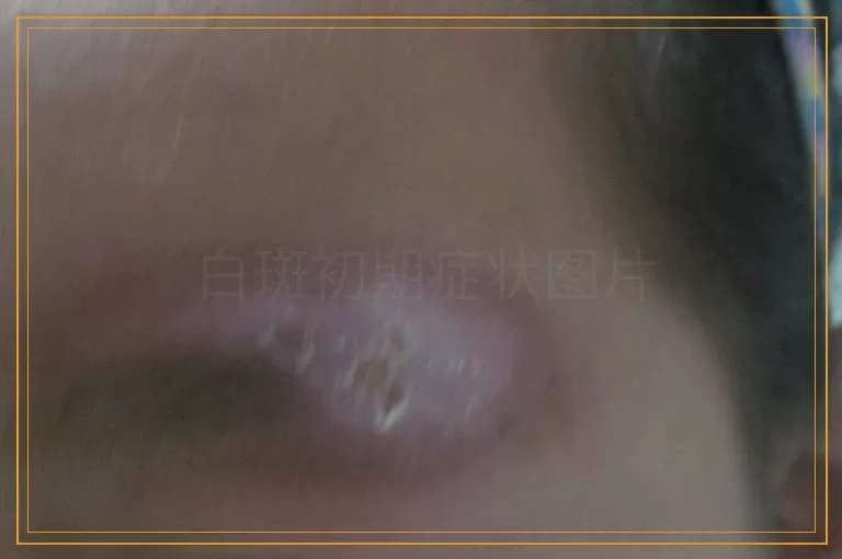 白斑初期症状图片