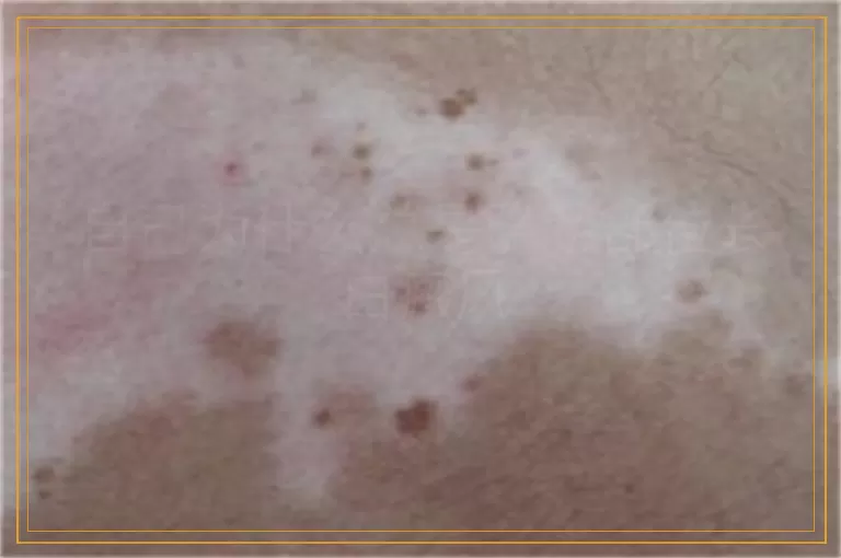 自己为什么总是隐私部位长白癜风