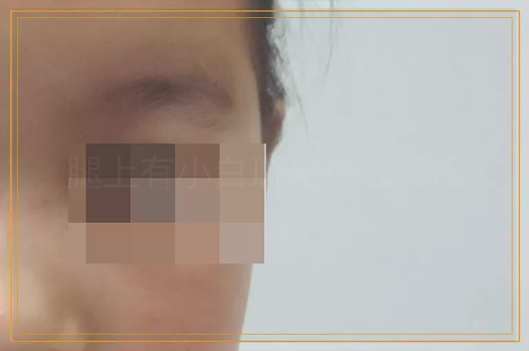 腿上有小白斑是什么原因