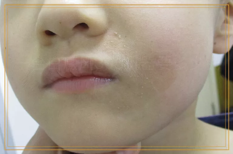 一台白癜风308机器要多少钱