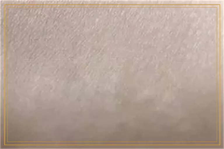 黑色素种植治白癜风效果如何