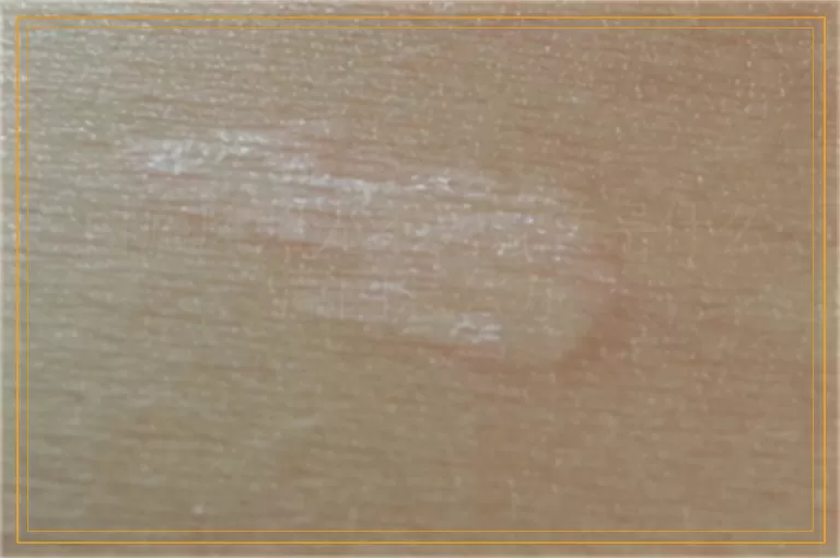 白癜风照光不见好转是什么原因怎么办