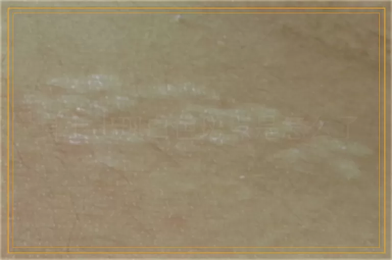 身上出现白色斑点是怎么了