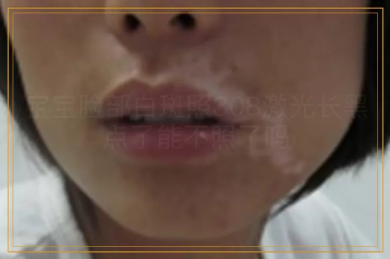 宝宝脸部白斑照308激光长黑点了能不照了吗