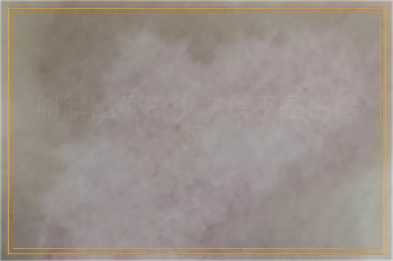 胳膊出现白斑块是不是白癜风