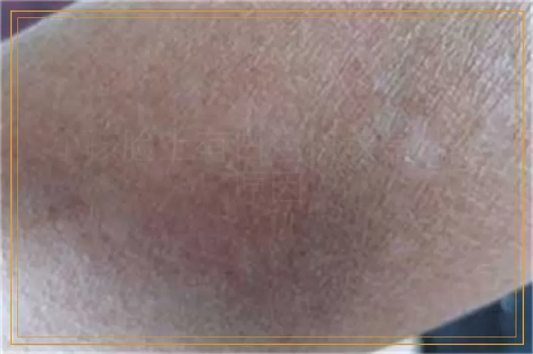 小孩脸上有白色斑块是什么原因