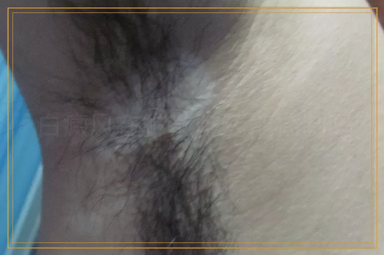 白癜风在扩散吃药能控制吗