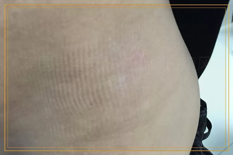 美国三维皮肤ct检查白癜风图