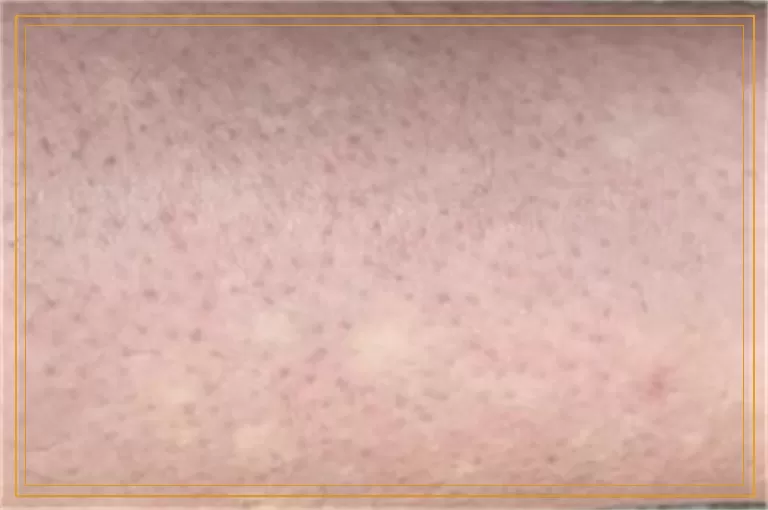 用什么检查是不是白癜风比较准