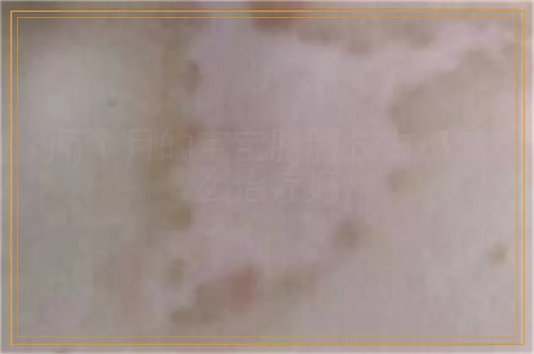 两个月的宝宝胳膊长白斑怎么治疗好