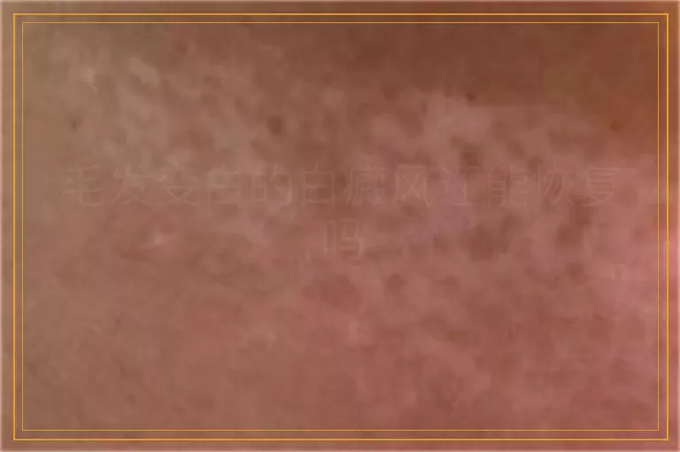 毛发变白的白癜风还能恢复吗