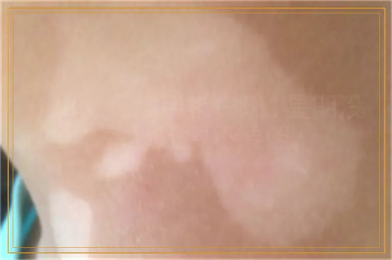 308激光照手指白斑1星期没效果还要不要照